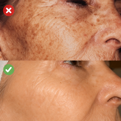 ClearSpot™ Creme | Reducer synlige alderspletter og pigmentforandringer