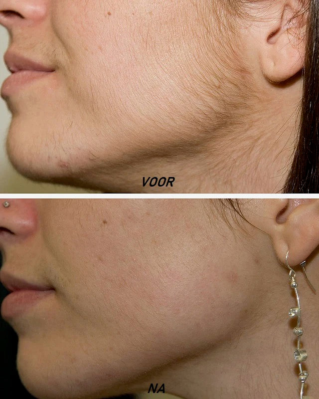 Ledora™ SmoothGlide Pro – Smertefri Hårfjerning med Præcision