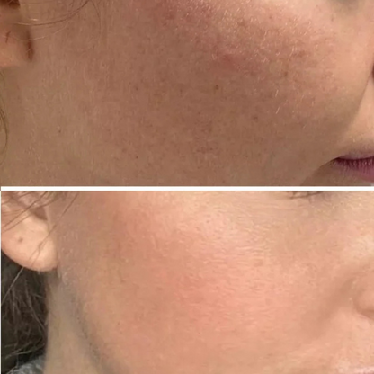 Ledora™ SmoothGlide Pro – Smertefri Hårfjerning med Præcision