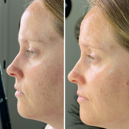 Ledora™ SmoothGlide Pro – Smertefri Hårfjerning med Præcision