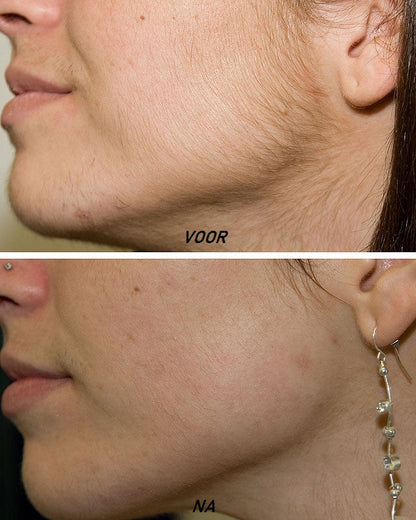 Ledora™ SmoothGlide Pro – Smertefri Hårfjerning med Præcision